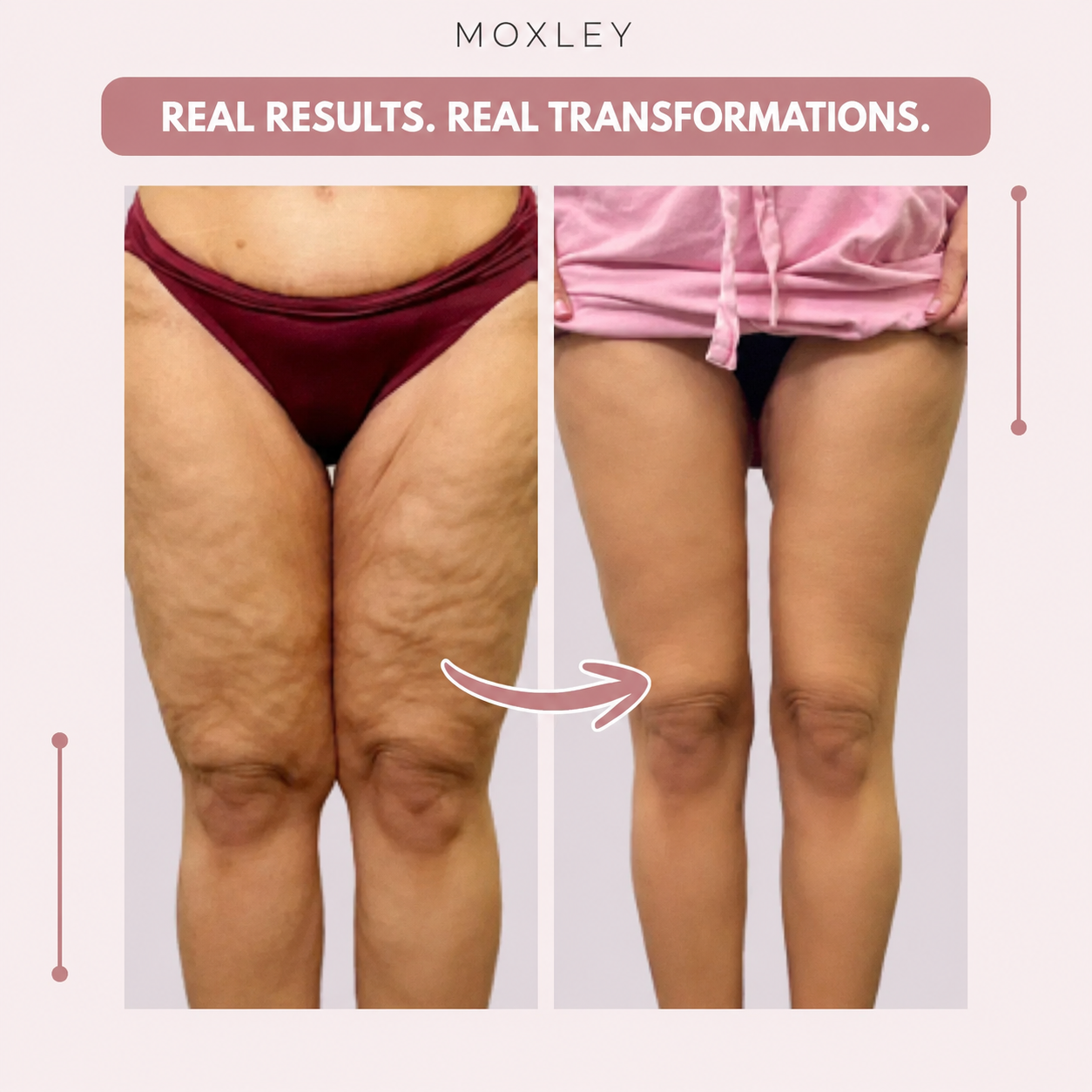 OLYVANE 3D Leggings – Naturally Say Goodbye to the Pain and Swelling of Lipoedema