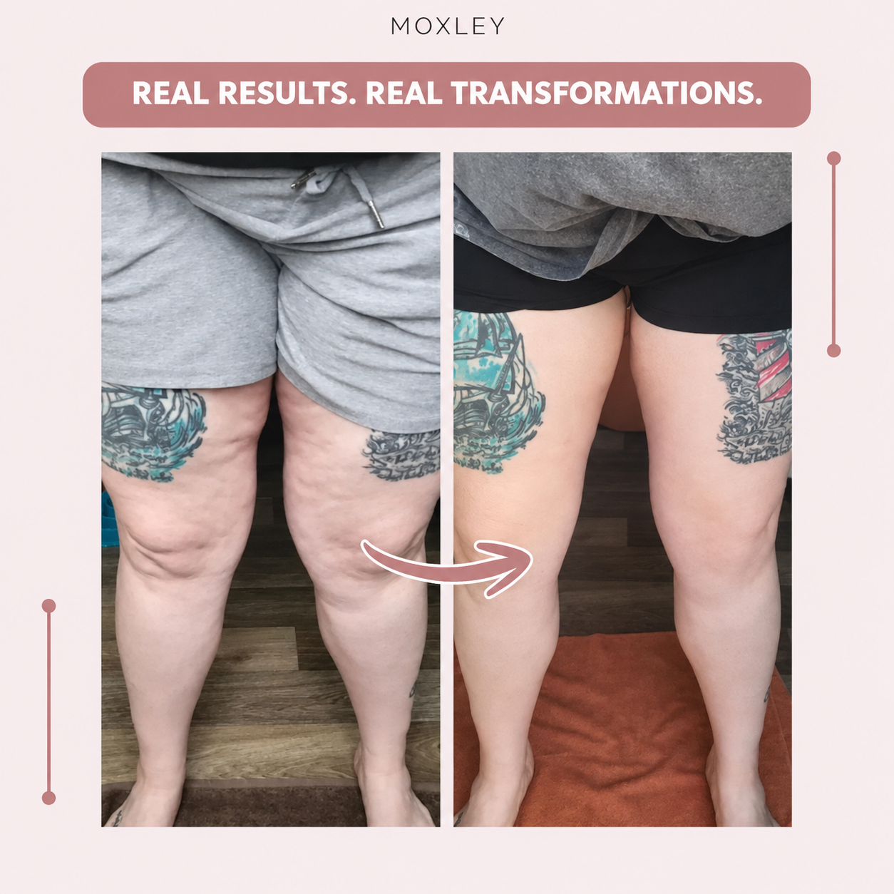 OLYVANE 3D Leggings – Naturally Say Goodbye to the Pain and Swelling of Lipoedema