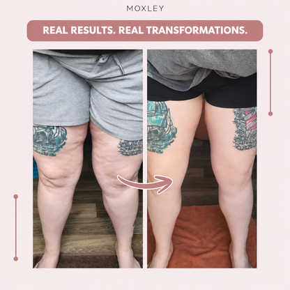 OLYVANE 3D Leggings – Naturally Say Goodbye to the Pain and Swelling of Lipoedema