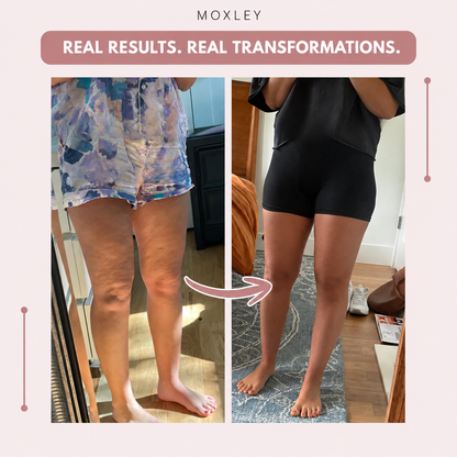 OLYVANE 3D Leggings – Naturally Say Goodbye to the Pain and Swelling of Lipoedema