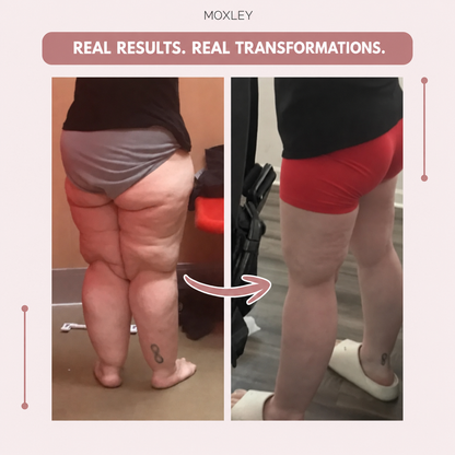OLYVANE 3D Leggings – Naturally Say Goodbye to the Pain and Swelling of Lipoedema